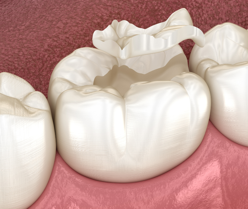 Are Dental Sealants Really Necessary for Kids?