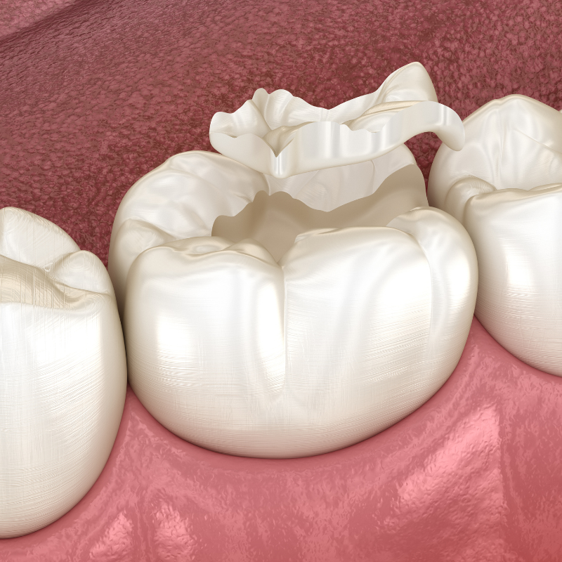 Are Dental Sealants Really Necessary for Kids?