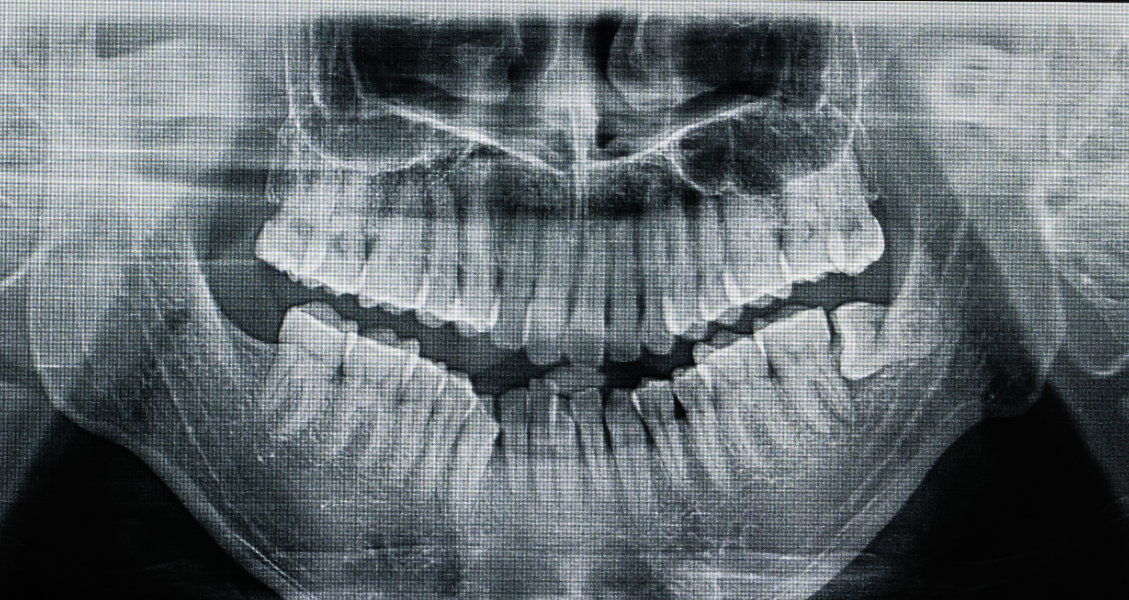Are Dental X-Rays Safe for Kids?