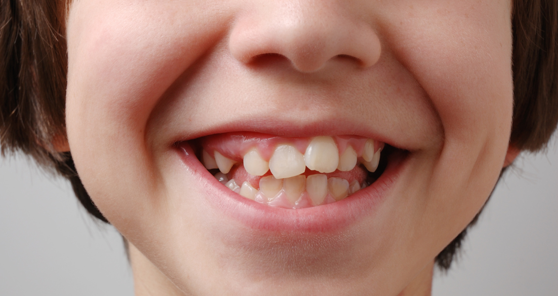 Why Are My Child’s Adult Teeth Coming In Crooked?