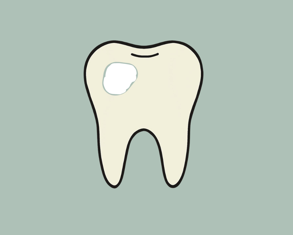 White Spot Lesions and Fluorosis
